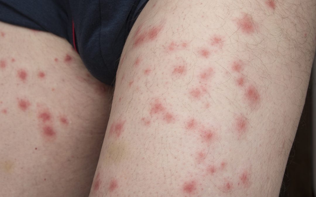 Signs and Treatment of Bed Bug Bites